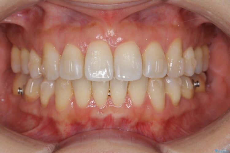 【20代女性】矯正後の後戻り、出っ歯の改善 治療途中画像