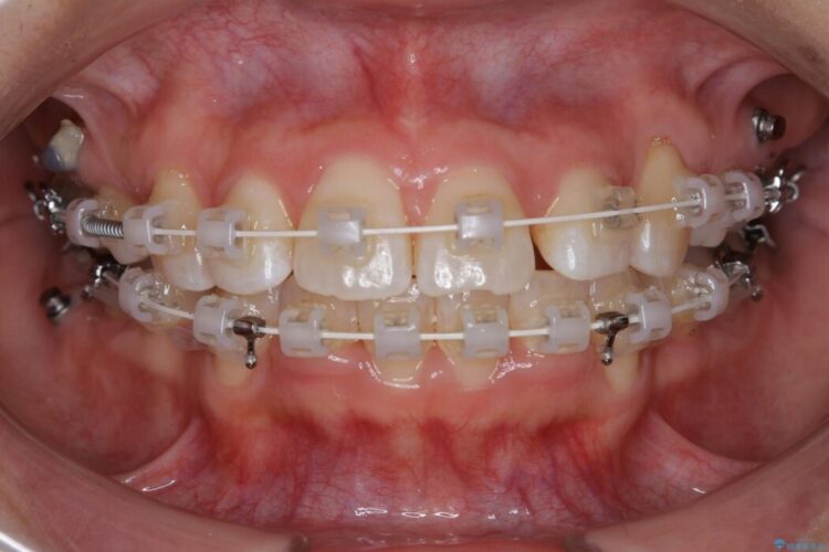 【20代女性】審美ワイヤー装置で出っ歯の改善 治療途中画像