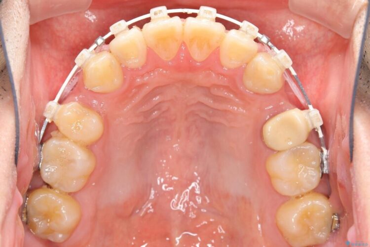 【30代男性】ワイヤー矯正で出っ歯とガタつきの改善 治療途中画像
