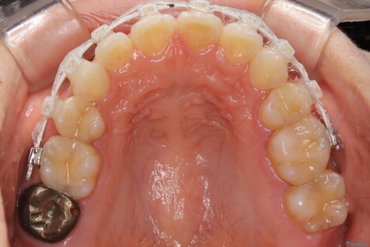 【20代女性】矯正治療後の後戻り 治療途中画像