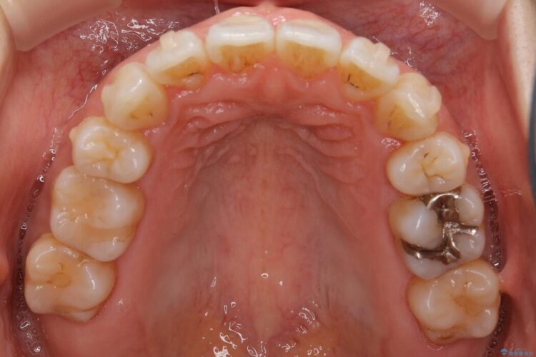 【20代女性】矯正後の後戻り、出っ歯の改善 治療途中画像