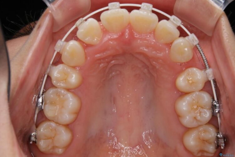 【20代女性】審美ワイヤー装置で出っ歯の改善 治療途中画像
