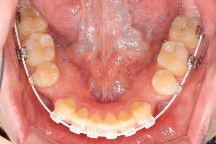 【30代男性】ワイヤー矯正で出っ歯とガタつきの改善 治療途中画像