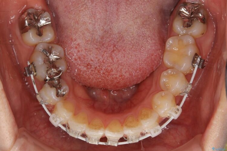 【20代女性】矯正治療後の後戻り 治療途中画像