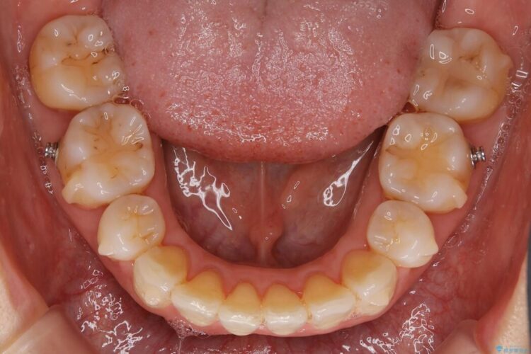 【20代女性】矯正後の後戻り、出っ歯の改善 治療途中画像