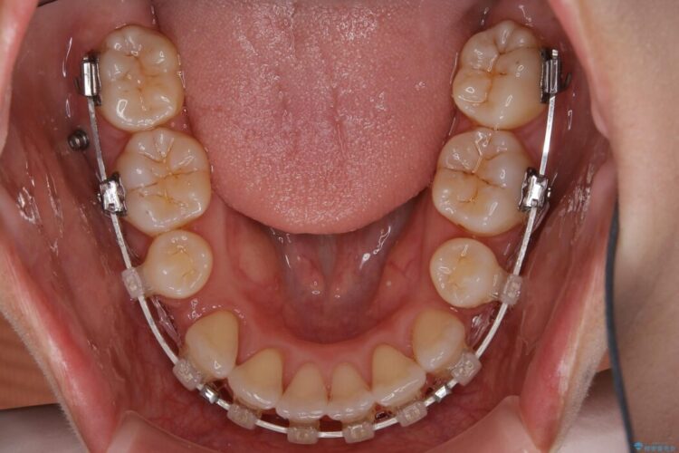 【20代女性】審美ワイヤー装置で出っ歯の改善 治療途中画像