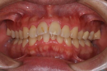 【30代男性】ワイヤー矯正で出っ歯とガタつきの改善 治療前