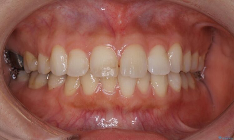 【20代女性】矯正治療後の後戻り 治療前画像