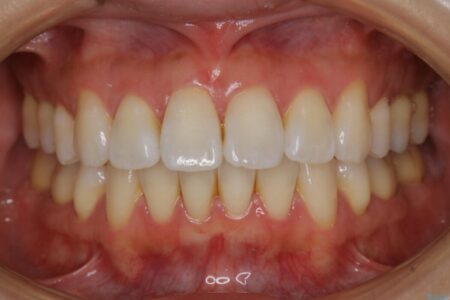 【20代女性】矯正後の後戻り、出っ歯の改善 治療前