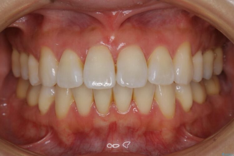 【20代女性】矯正後の後戻り、出っ歯の改善 治療前画像