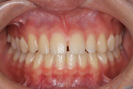 【10代女性】インビザラインライトで短期矯正 治療前