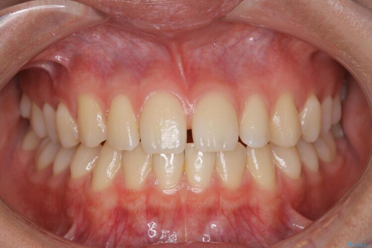 【10代女性】インビザラインライトで短期矯正 治療前画像