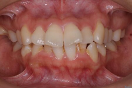 【20代女性】審美ワイヤー装置で出っ歯の改善 治療前