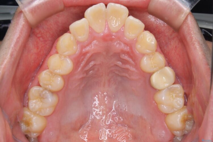 【30代男性】ワイヤー矯正で出っ歯とガタつきの改善 治療前画像