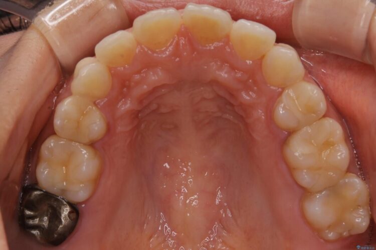 【20代女性】矯正治療後の後戻り 治療前画像
