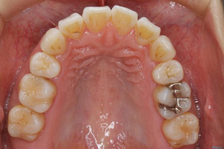 【20代女性】矯正後の後戻り、出っ歯の改善 治療前画像