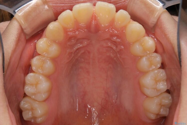 【10代女性】インビザラインライトで短期矯正 治療前画像