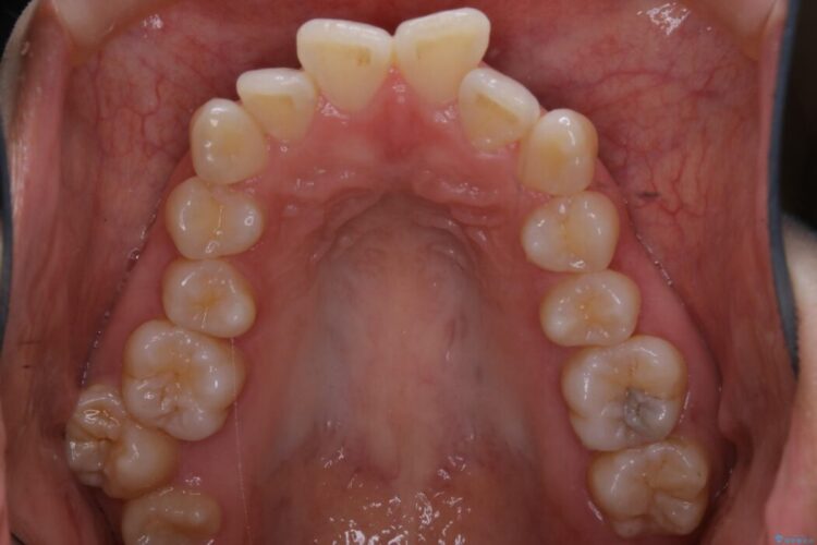 【20代女性】審美ワイヤー装置で出っ歯の改善 治療前画像