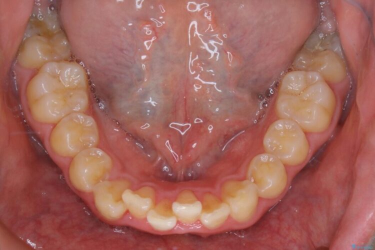 【30代男性】ワイヤー矯正で出っ歯とガタつきの改善 治療前画像