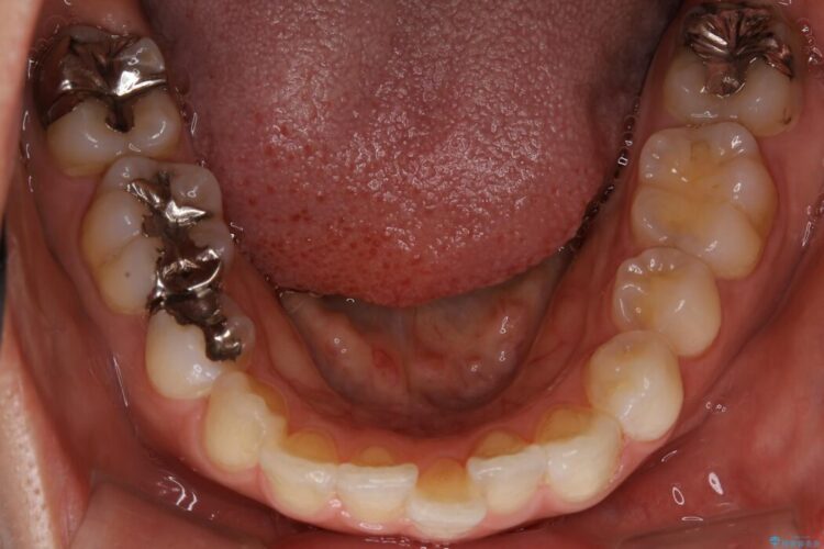 【20代女性】矯正治療後の後戻り 治療前画像