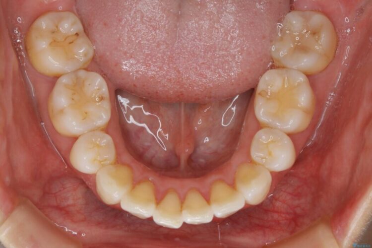 【20代女性】矯正後の後戻り、出っ歯の改善 治療前画像