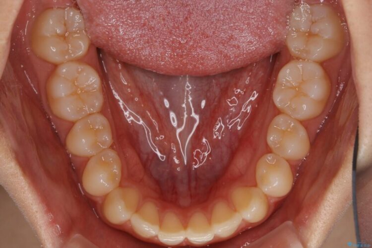 【10代女性】インビザラインライトで短期矯正 治療前画像