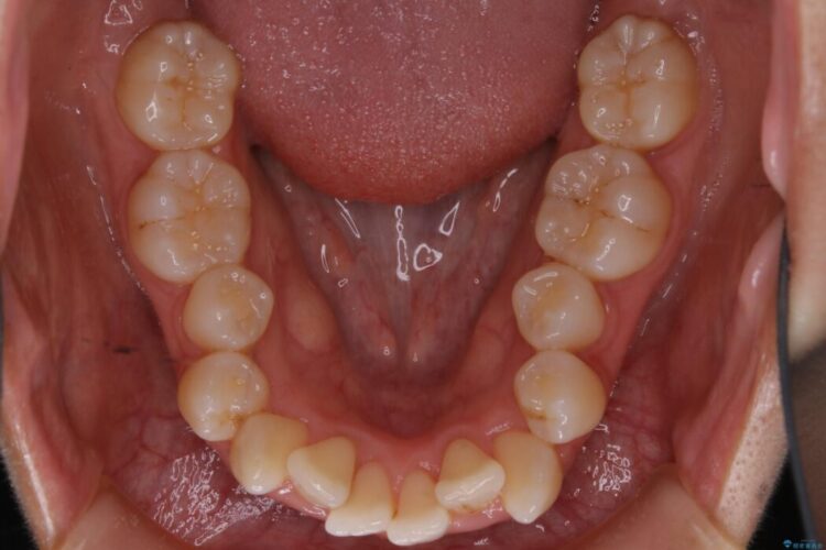 【20代女性】審美ワイヤー装置で出っ歯の改善 治療前画像