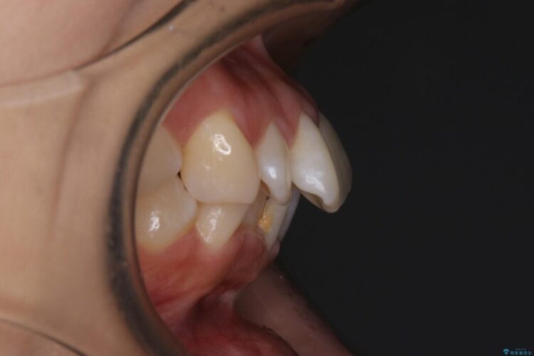 【20代女性】審美ワイヤー装置で出っ歯の改善 治療前画像