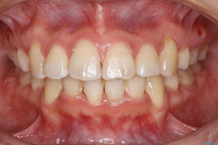 【20代女性】審美ワイヤー装置で出っ歯の改善 治療後画像