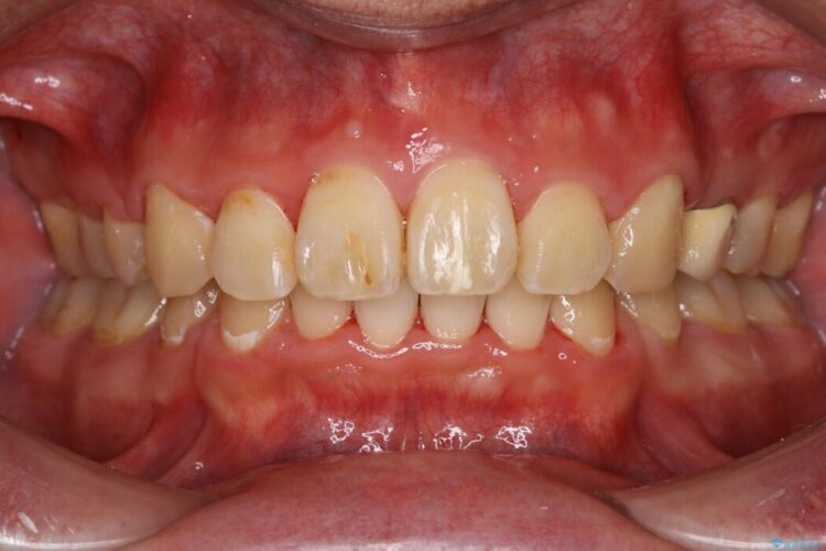 【30代男性】ワイヤー矯正で出っ歯とガタつきの改善 治療後画像