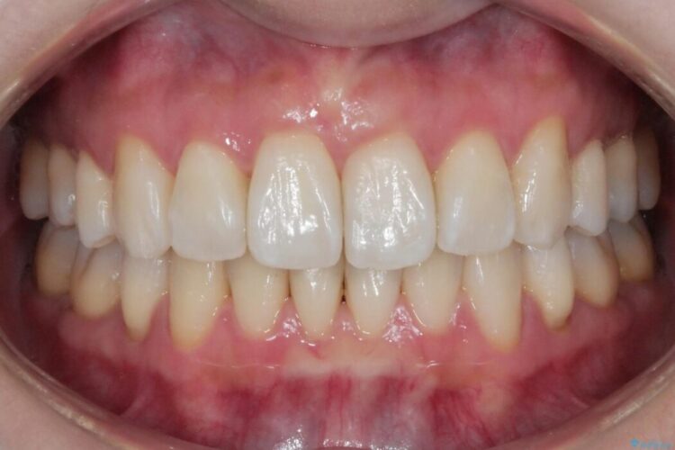 【20代女性】矯正後の後戻り、出っ歯の改善 治療後画像