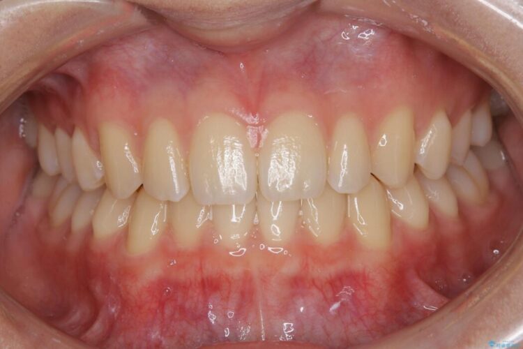 【10代女性】インビザラインライトで短期矯正 治療後画像