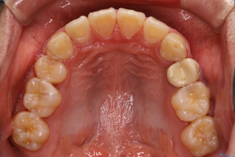 【30代男性】ワイヤー矯正で出っ歯とガタつきの改善 治療後画像
