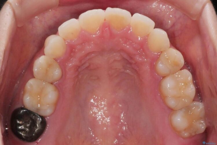 【20代女性】矯正治療後の後戻り 治療後画像