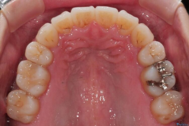 【20代女性】矯正後の後戻り、出っ歯の改善 治療後画像