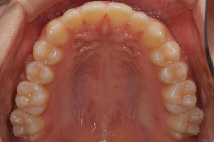【10代女性】インビザラインライトで短期矯正 治療後画像