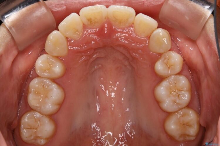 【20代女性】審美ワイヤー装置で出っ歯の改善 治療後画像