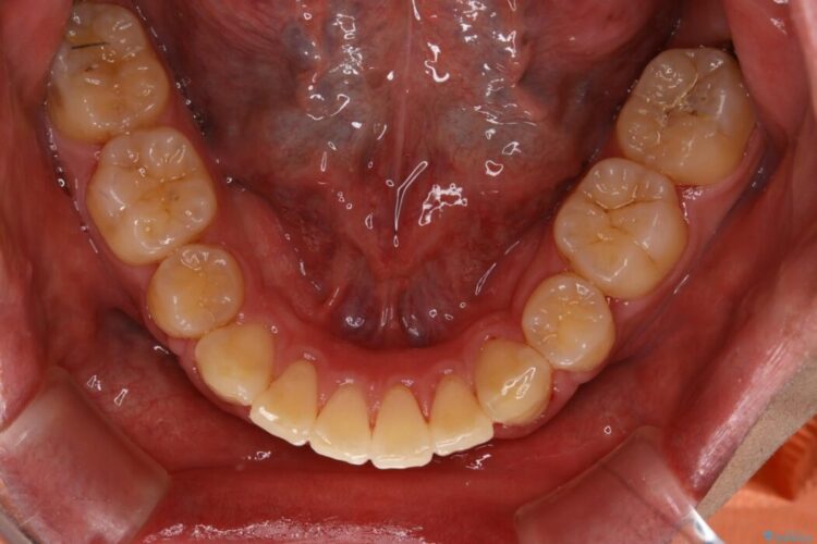 【30代男性】ワイヤー矯正で出っ歯とガタつきの改善 治療後画像