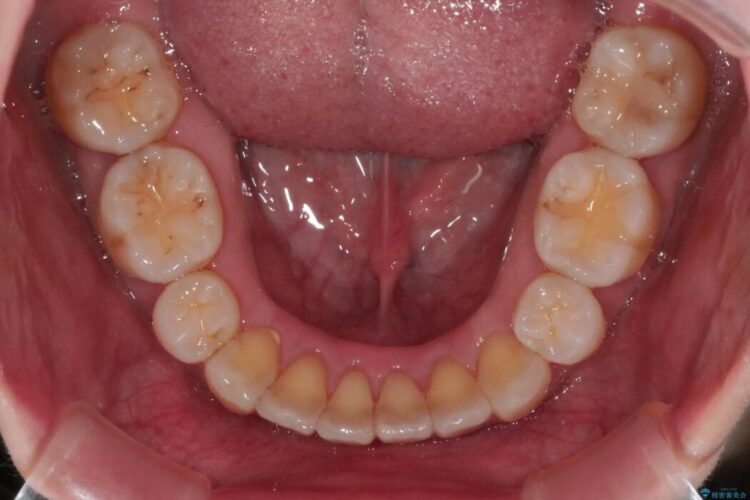 【20代女性】矯正後の後戻り、出っ歯の改善 治療後画像