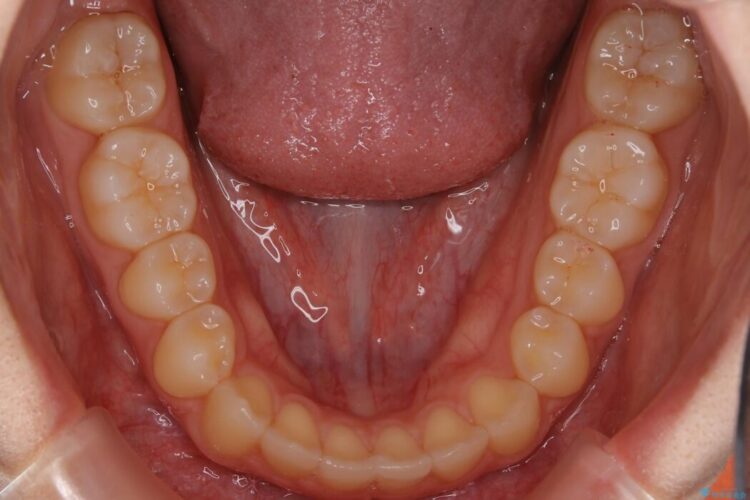 【10代女性】インビザラインライトで短期矯正 治療後画像