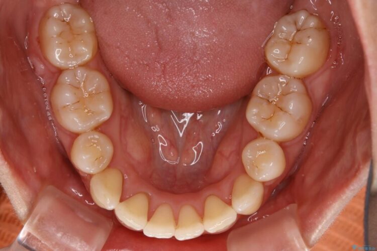 【20代女性】審美ワイヤー装置で出っ歯の改善 治療後画像