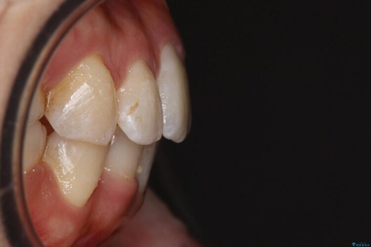 【20代女性】審美ワイヤー装置で出っ歯の改善 治療後画像