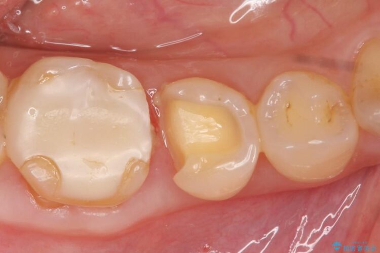 【40代女性】古い不適合な詰め物をセラミックインレーで再治療 治療途中画像