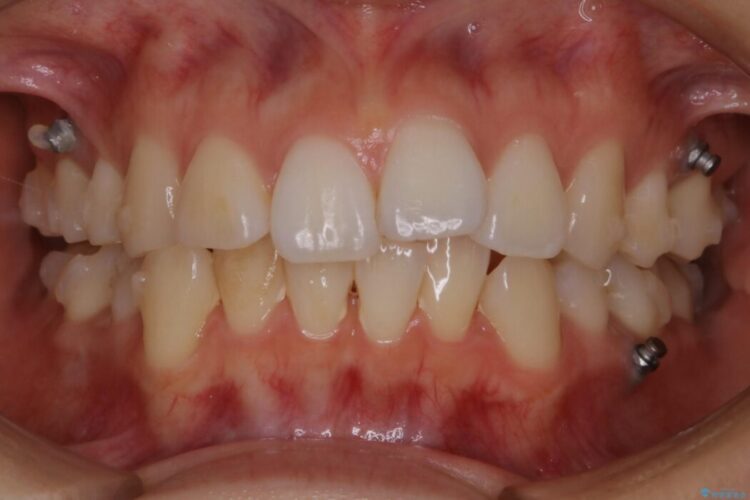 【20代女性】10代の頃にした矯正の後戻りを再矯正する 治療途中画像