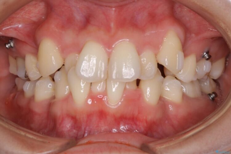 【20代女性】抜歯矯正で叢生をなおす 治療途中画像