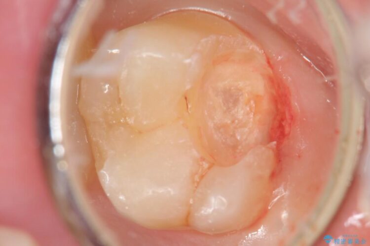 【20代男性】深い虫歯を長持ちするゴールドインレーで治療 治療途中画像