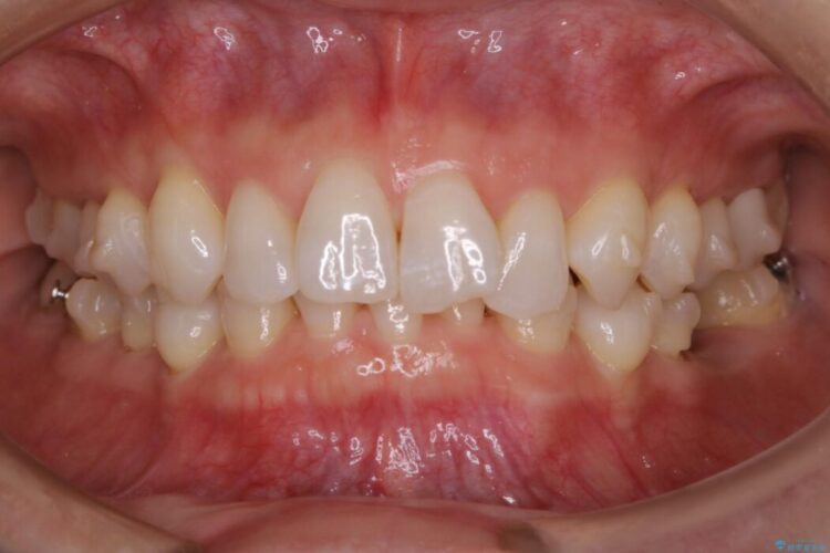 【30代女性】歯根破折と歯列矯正の治療で噛み合わせを改善 治療途中画像