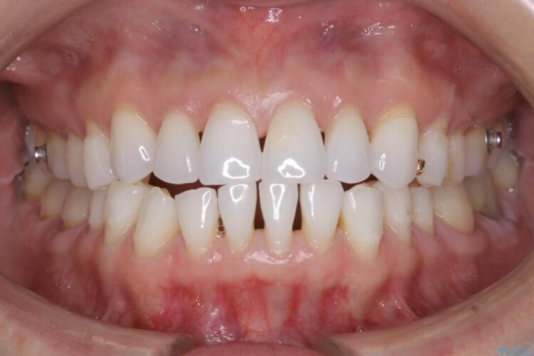 【40代女性】開咬(オープンバイト)の非抜歯インビザライン矯正治療 治療途中画像