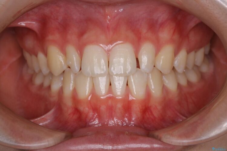 【10代女性】生まれつき小さい歯をセラミックで補綴しすきっ歯を改善する 治療途中画像