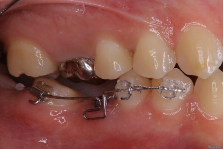 【20代女性】傾斜してしまった奥歯の部分矯正を併用したブリッジ治療 治療途中画像